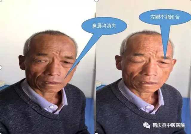 鹤庆县中医院针灸科针灸、中药综合治疗面瘫病疗效满意(图1)